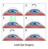Lasik eye surgery